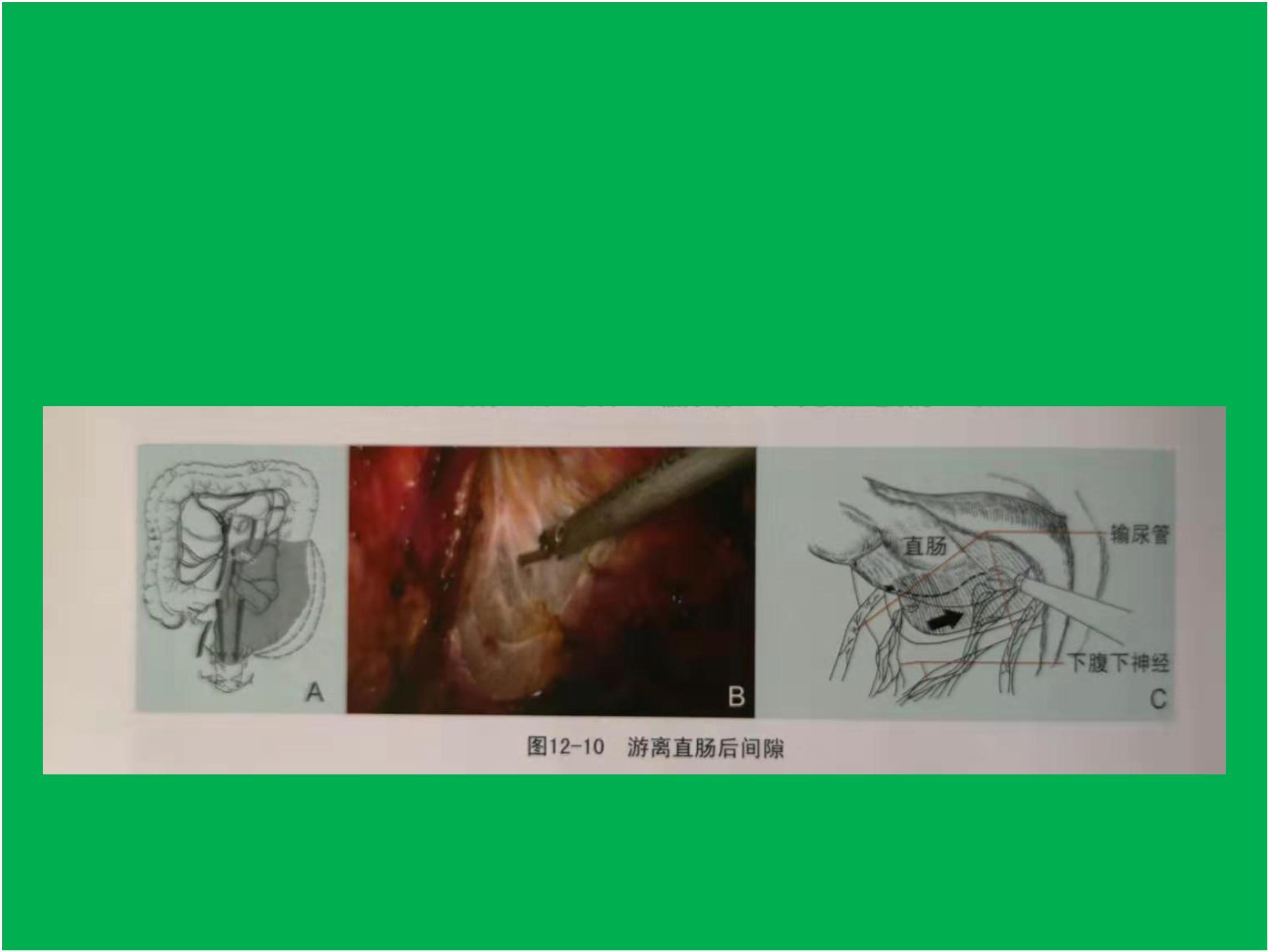 结直肠癌并非不治之症早发现癌症也可以治愈