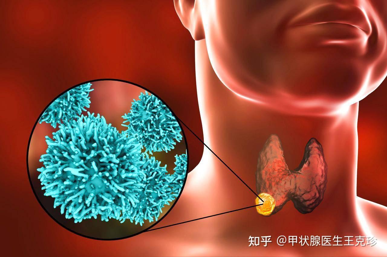 甲状腺结节就要“一切了之”吗？